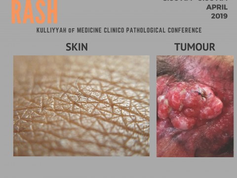 "A PRIVATE RASH" - KOM CPC BY DEPT. OF SURGERY - 12 APRIL 2019 (8.00 A.M)